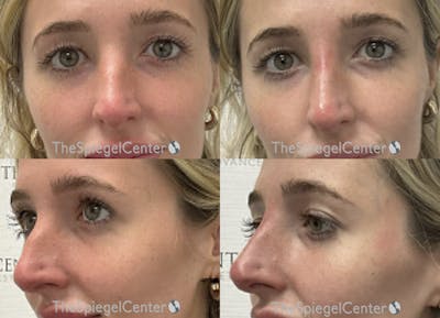 Non-Surgical Rhinoplasty / Nose Filler Before & After Gallery - Patient 555171 - Image 1