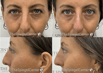 Non-Surgical Rhinoplasty / Nose Filler Before & After Gallery - Patient 260887 - Image 1