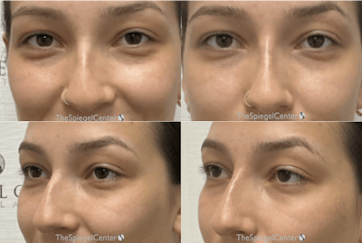 Non-Surgical Rhinoplasty / Nose Filler Before & After Gallery - Patient 270987 - Image 1