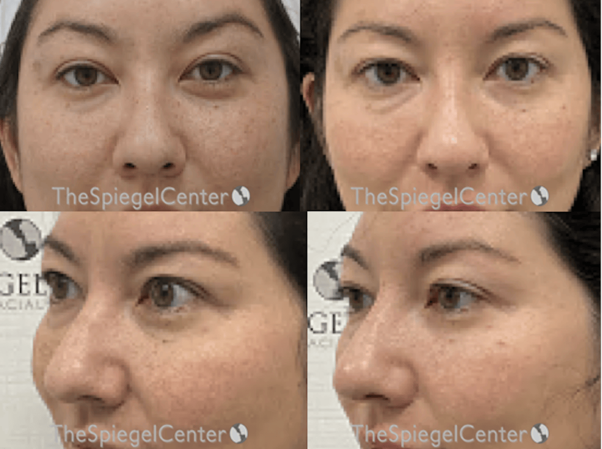 Non-Surgical Rhinoplasty / Nose Filler Before & After Gallery - Patient 443439 - Image 1