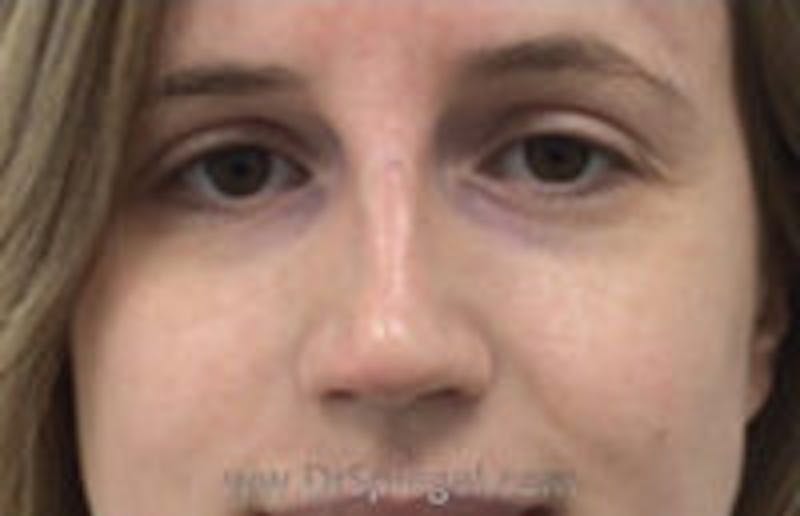 Non-Surgical Rhinoplasty / Nose Filler Before & After Gallery - Patient 173701 - Image 2