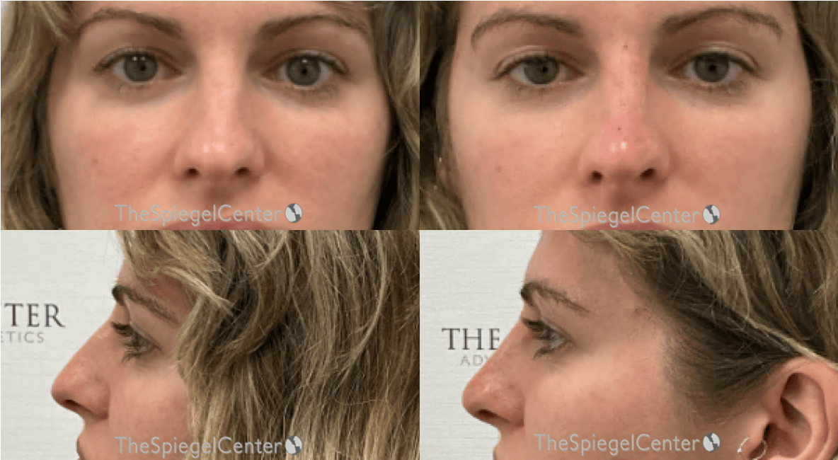 Non-Surgical Rhinoplasty / Nose Filler Before & After Gallery - Patient 264018 - Image 1