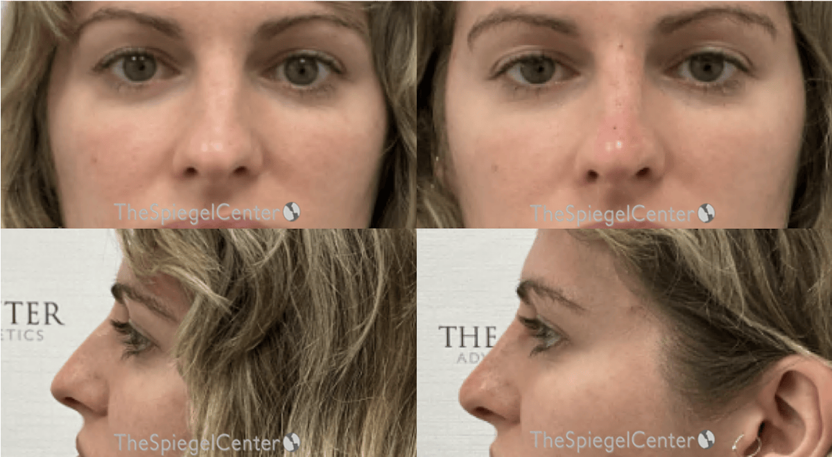 Non-Surgical Rhinoplasty / Nose Filler Before & After Gallery - Patient 264018 - Image 1