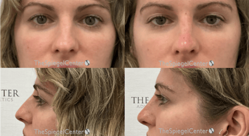 Non-Surgical Rhinoplasty / Nose Filler Before & After Gallery - Patient 264018 - Image 1