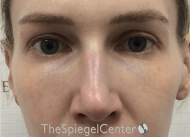 Non-Surgical Rhinoplasty / Nose Filler Before & After Gallery - Patient 130909 - Image 1