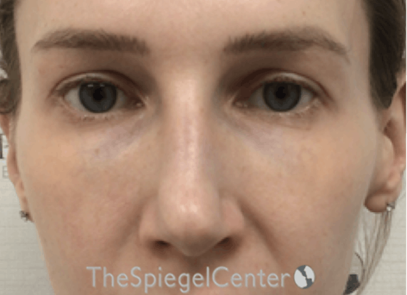 Non-Surgical Rhinoplasty / Nose Filler Before & After Gallery - Patient 130909 - Image 2