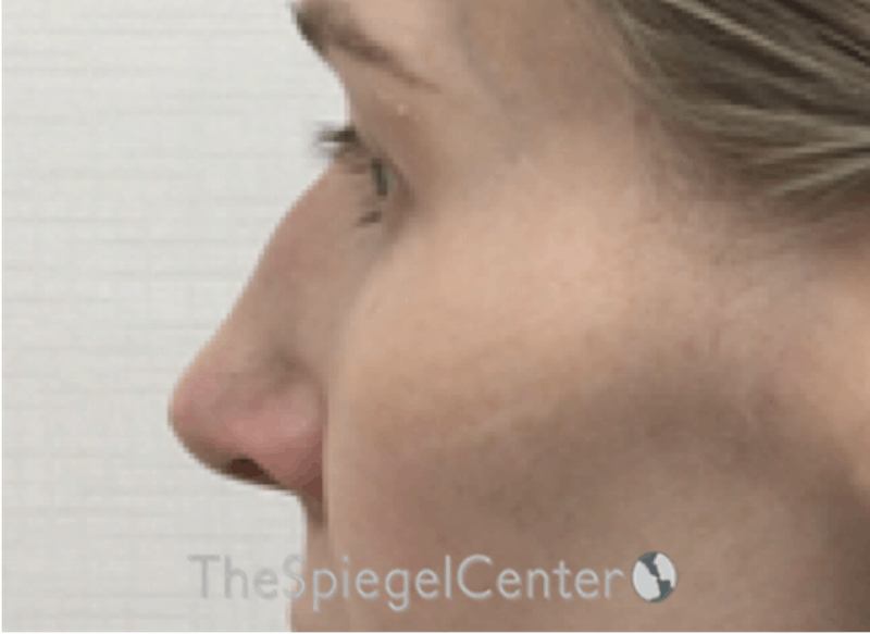 Non-Surgical Rhinoplasty / Nose Filler Before & After Gallery - Patient 130909 - Image 3