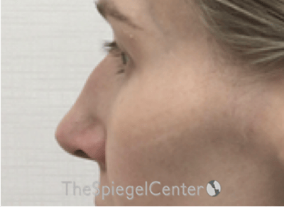Non-Surgical Rhinoplasty / Nose Filler Before & After Gallery - Patient 130909 - Image 3