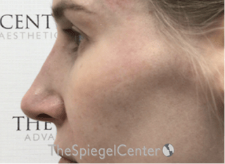 Non-Surgical Rhinoplasty / Nose Filler Before & After Gallery - Patient 130909 - Image 4