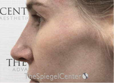 Non-Surgical Rhinoplasty / Nose Filler Before & After Gallery - Patient 130909 - Image 4