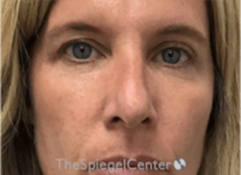 Non-Surgical Rhinoplasty / Nose Filler Before & After Gallery - Patient 202319 - Image 1