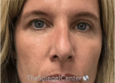 Non-Surgical Rhinoplasty / Nose Filler Before & After Gallery - Patient 202319 - Image 1