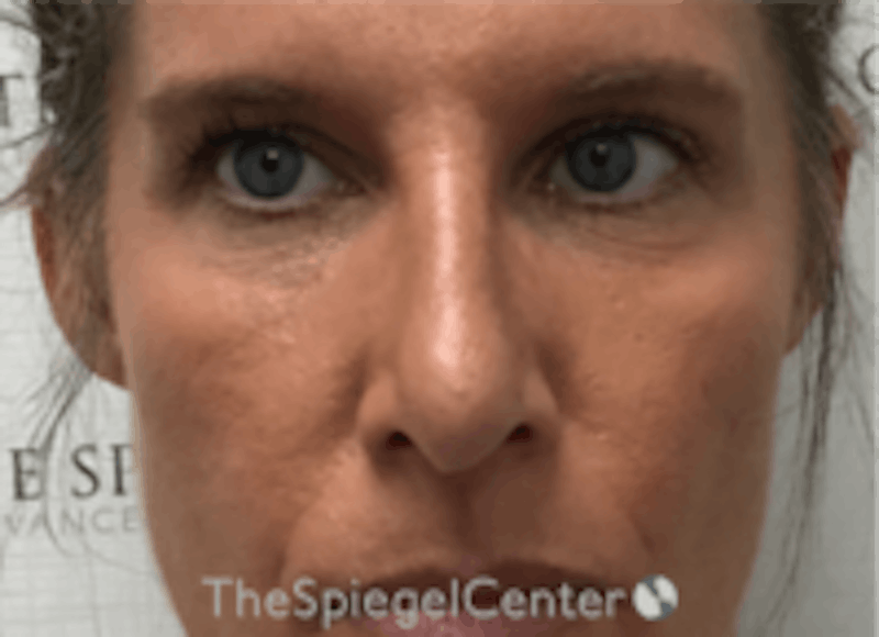 Non-Surgical Rhinoplasty / Nose Filler Before & After Gallery - Patient 202319 - Image 2