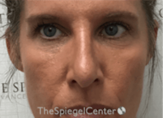 Non-Surgical Rhinoplasty / Nose Filler Before & After Gallery - Patient 202319 - Image 2