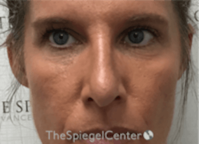 Non-Surgical Rhinoplasty / Nose Filler Before & After Gallery - Patient 202319 - Image 2