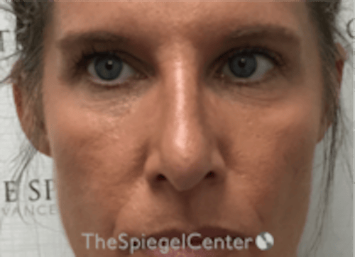 Non-Surgical Rhinoplasty / Nose Filler Before & After Gallery - Patient 202319 - Image 2