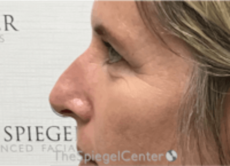 Non-Surgical Rhinoplasty / Nose Filler Before & After Gallery - Patient 202319 - Image 3