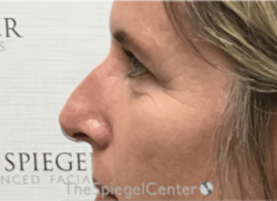 Non-Surgical Rhinoplasty / Nose Filler Before & After Gallery - Patient 202319 - Image 3