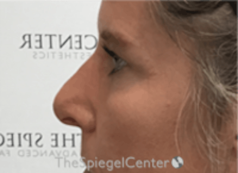 Non-Surgical Rhinoplasty / Nose Filler Before & After Gallery - Patient 202319 - Image 4