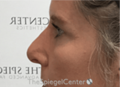 Non-Surgical Rhinoplasty / Nose Filler Before & After Gallery - Patient 202319 - Image 4
