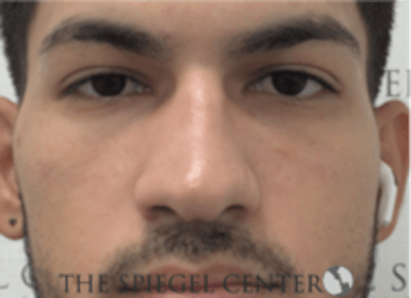 Non-Surgical Rhinoplasty / Nose Filler Before & After Gallery - Patient 287913 - Image 1