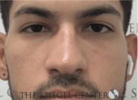 Non-Surgical Rhinoplasty / Nose Filler Before & After Gallery - Patient 287913 - Image 1