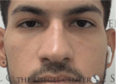 Non-Surgical Rhinoplasty / Nose Filler Before & After Gallery - Patient 287913 - Image 1