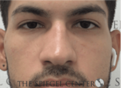 Non-Surgical Rhinoplasty / Nose Filler Before & After Gallery - Patient 287913 - Image 1