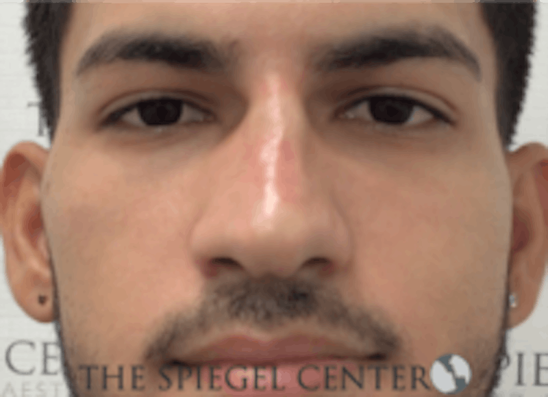 Non-Surgical Rhinoplasty / Nose Filler Before & After Gallery - Patient 287913 - Image 2