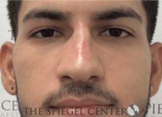 Non-Surgical Rhinoplasty / Nose Filler Before & After Gallery - Patient 287913 - Image 2