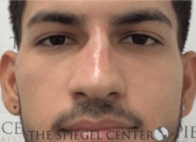 Non-Surgical Rhinoplasty / Nose Filler Before & After Gallery - Patient 287913 - Image 2