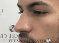 Non-Surgical Rhinoplasty / Nose Filler Before & After Gallery - Patient 287913 - Image 3