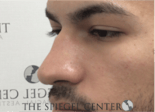 Non-Surgical Rhinoplasty / Nose Filler Before & After Gallery - Patient 287913 - Image 3