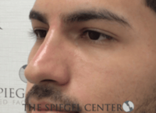 Non-Surgical Rhinoplasty / Nose Filler Before & After Gallery - Patient 287913 - Image 4