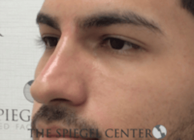 Non-Surgical Rhinoplasty / Nose Filler Before & After Gallery - Patient 287913 - Image 4