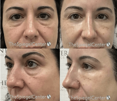 Non-Surgical Rhinoplasty / Nose Filler Before & After Gallery - Patient 107211 - Image 1