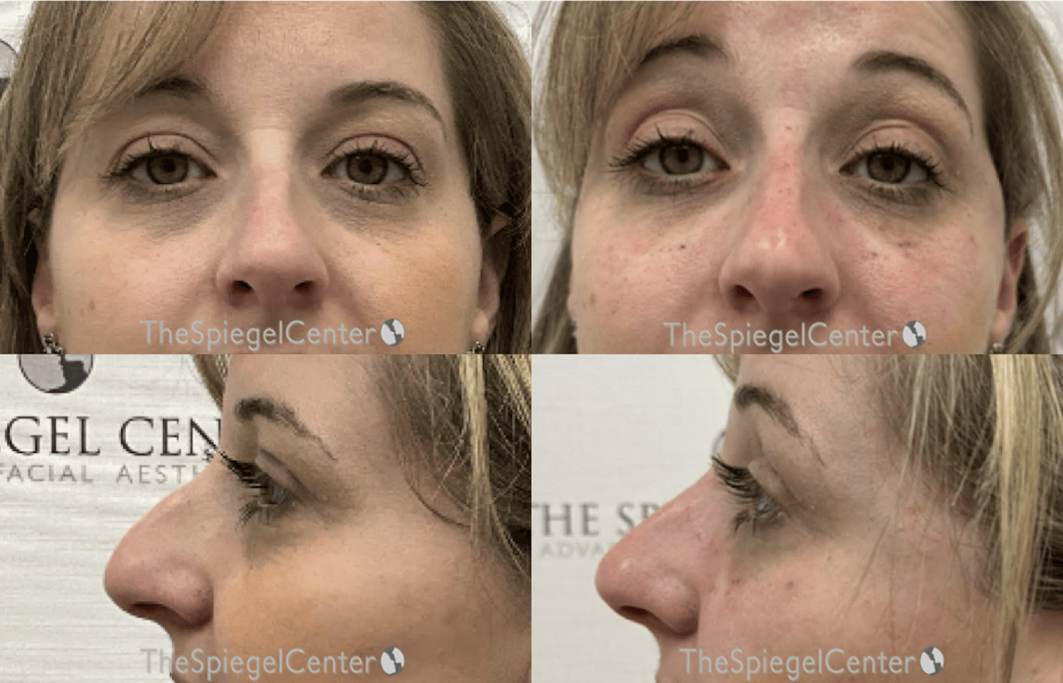 Non-Surgical Rhinoplasty / Nose Filler Before & After Gallery - Patient 386756 - Image 1