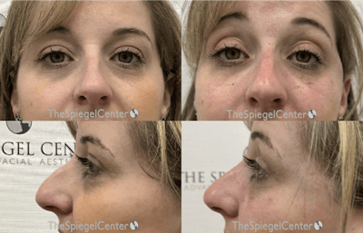Non-Surgical Rhinoplasty / Nose Filler Before & After Gallery - Patient 386756 - Image 1