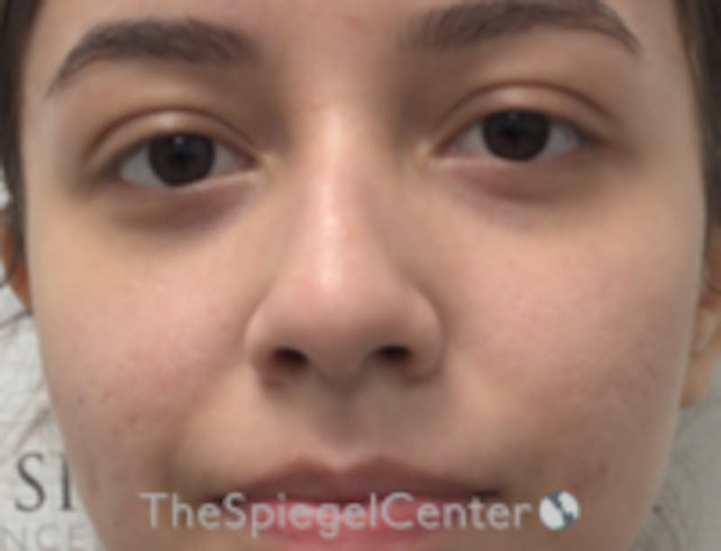 Non-Surgical Rhinoplasty / Nose Filler Before & After Gallery - Patient 103424 - Image 1
