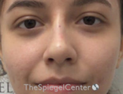 Non-Surgical Rhinoplasty / Nose Filler Before & After Gallery - Patient 103424 - Image 2