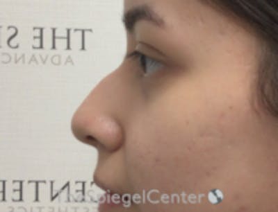 Non-Surgical Rhinoplasty / Nose Filler Before & After Gallery - Patient 103424 - Image 3