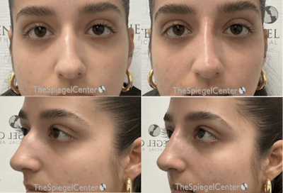 Non-Surgical Rhinoplasty / Nose Filler Before & After Gallery - Patient 290059 - Image 1