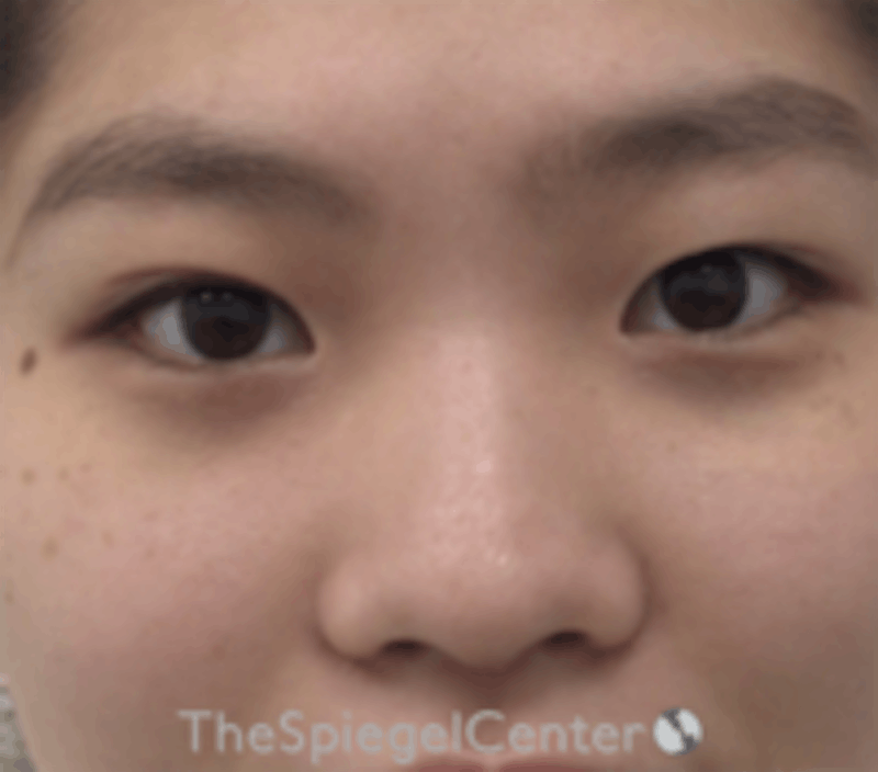 Non-Surgical Rhinoplasty / Nose Filler Before & After Gallery - Patient 212825 - Image 1
