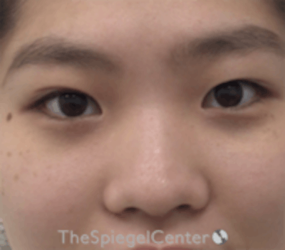 Non-Surgical Rhinoplasty Before & After Gallery - Patient 676344 - Image 1