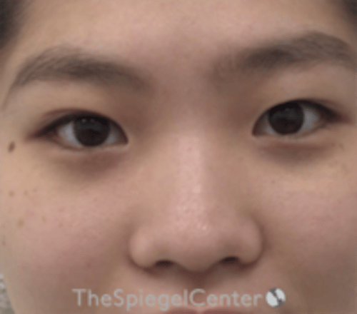 Non-Surgical Rhinoplasty Before & After Gallery - Patient 676344 - Image 1