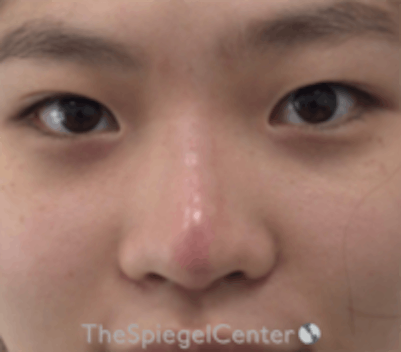 Non-Surgical Rhinoplasty / Nose Filler Before & After Gallery - Patient 212825 - Image 2