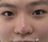Non-Surgical Rhinoplasty Before & After Gallery - Patient 676344 - Image 2