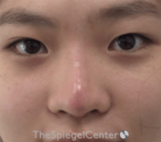 Non-Surgical Rhinoplasty / Nose Filler Before & After Gallery - Patient 212825 - Image 2
