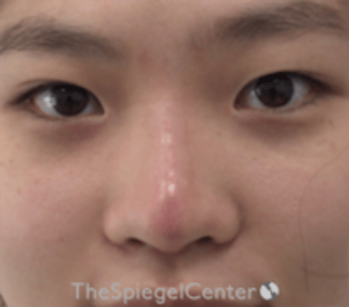 Non-Surgical Rhinoplasty Before & After Gallery - Patient 676344 - Image 2