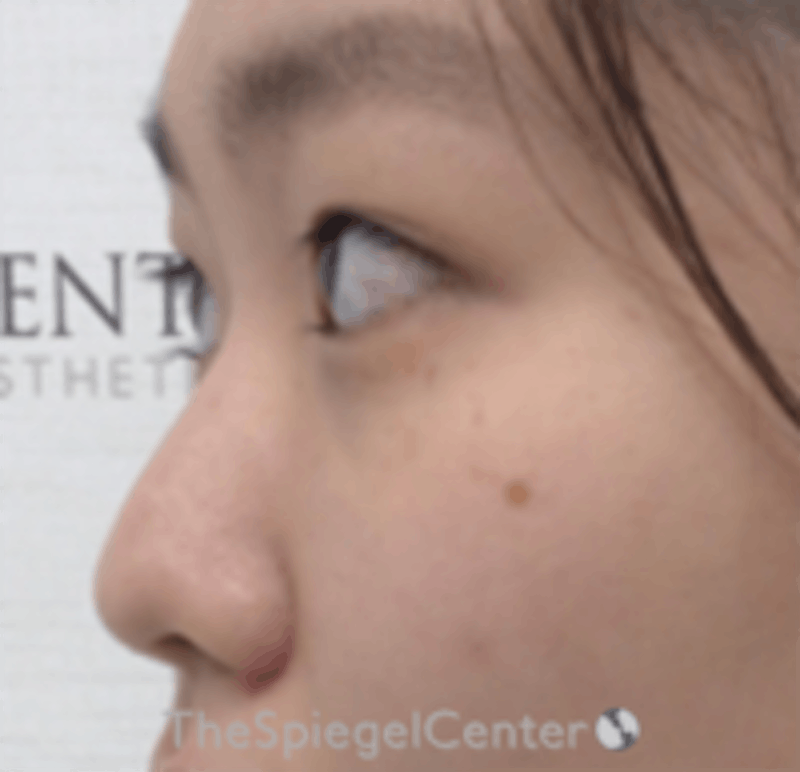 Non-Surgical Rhinoplasty / Nose Filler Before & After Gallery - Patient 212825 - Image 3